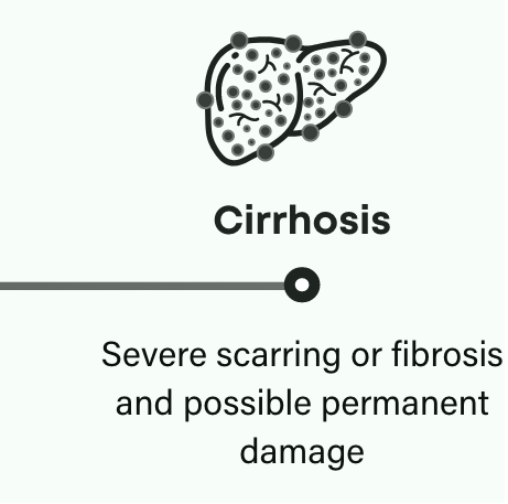 How NASH progresses: Cirrhosis is severe scarring or fibrosis that can result in possible permeant damage