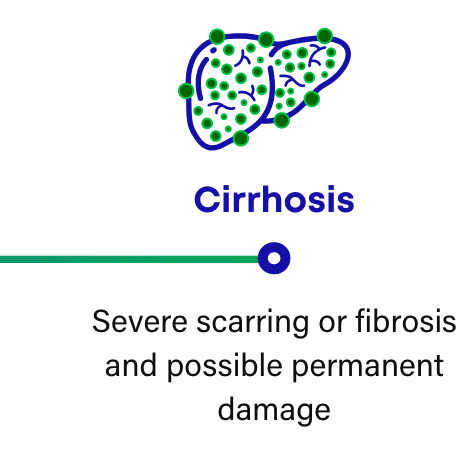 How NASH progresses: Cirrhosis is severe scarring or fibrosis that can result in possible permeant damage