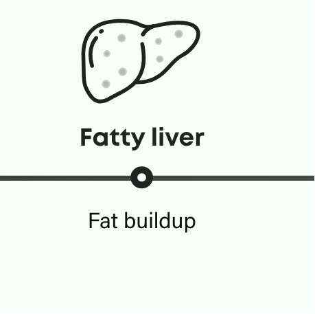 How NASH progresses: fatty liver has fat buildup