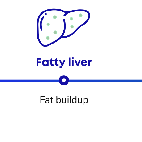 How NASH progresses: fatty liver has fat buildup