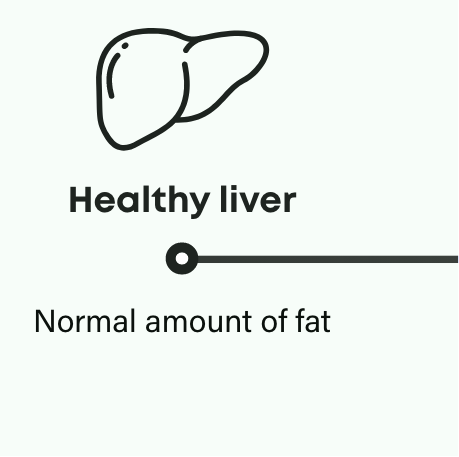 How NASH progresses: Healthy liver has a normal amount of fat