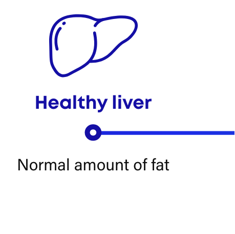 How NASH progresses: Healthy liver has a normal amount of fat