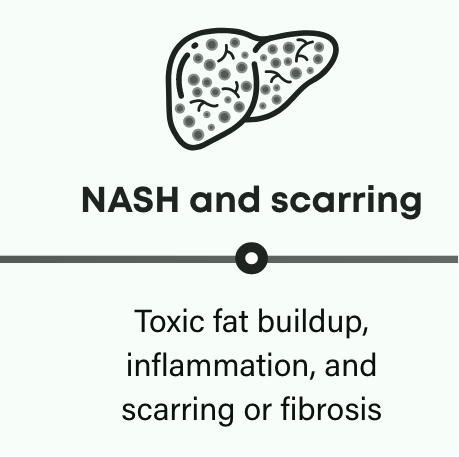 How NASH progresses: NASH and scarring in the liver can cause toxic fat buildup, inflammation, and scarring or fibrosis