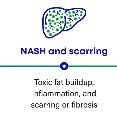 How NASH progresses: NASH and scarring in the liver can cause toxic fat buildup, inflammation, and scarring or fibrosis