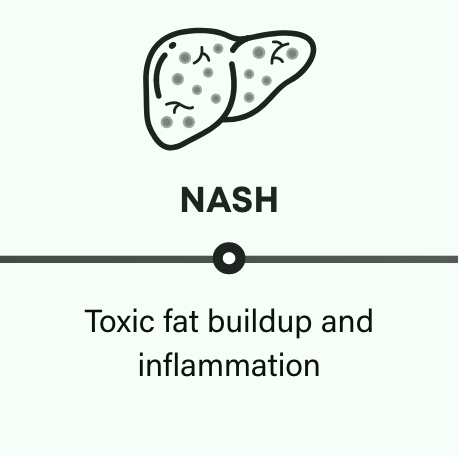 How NASH progresses: NASH can cause toxic buildup and inflammation